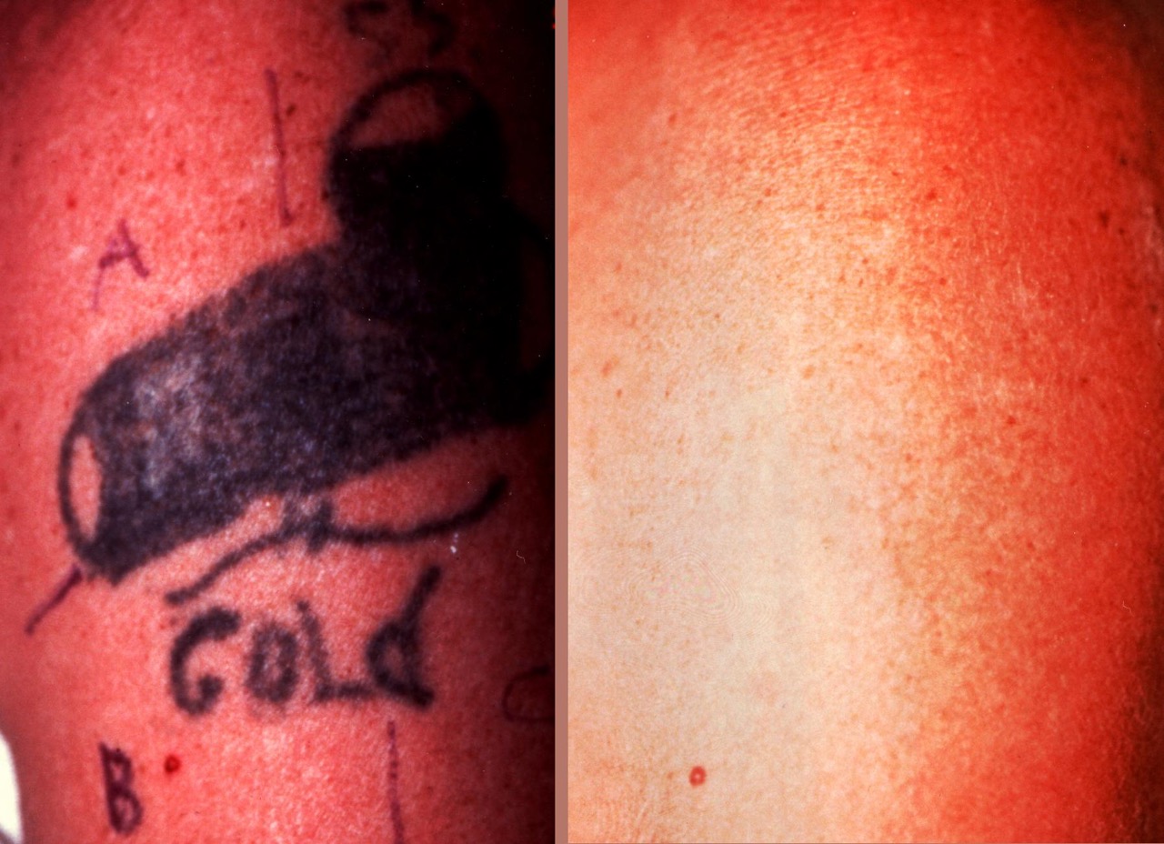 Rimozione tatuaggi a Pescara e a Roma - photo 4